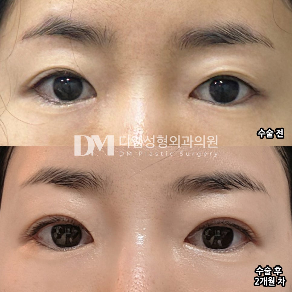 눈재수술 후기."많이 자연스러워진 것 같아요 라인도 아주 마음에 들어요!" 관련 이미지 2