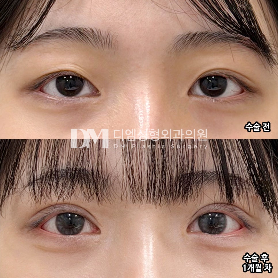 디엠 눈재수술 후기, &ldquo;거울 볼 때마다 너무 행복해요!&rdquo; 관련 이미지 2
