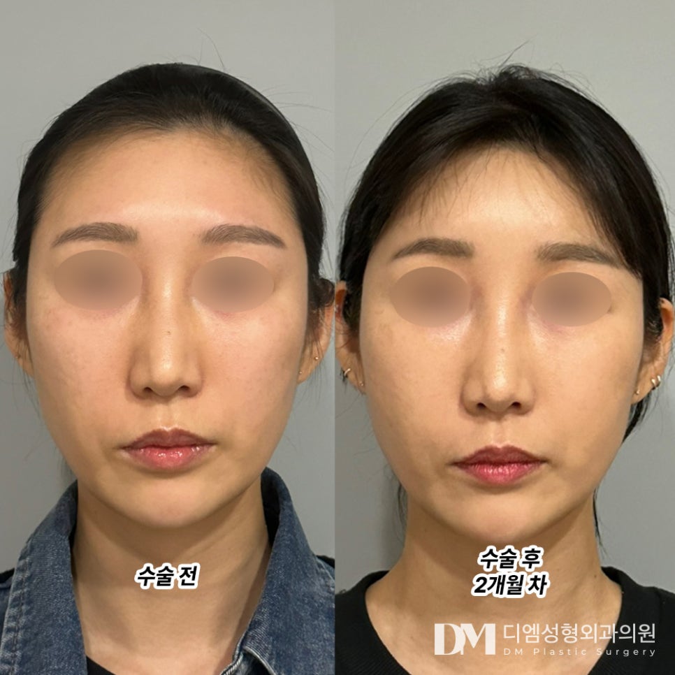 Facial Fat Grafting Review. "Instead of reusing the first fat, they harvested it from my thighs again!" image 2