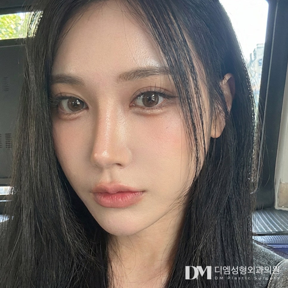 얼굴지방이식 전후사진, 적당히 차오르는 볼륨감 관련 이미지 1