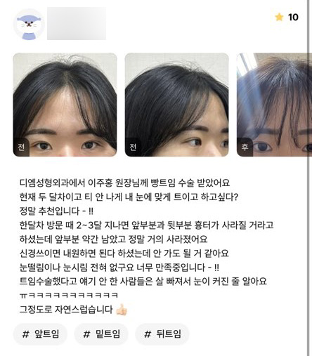트임성형 후기."살빠져서 눈이 커진 줄 알정도로 자연스러워요!" 관련 이미지 1