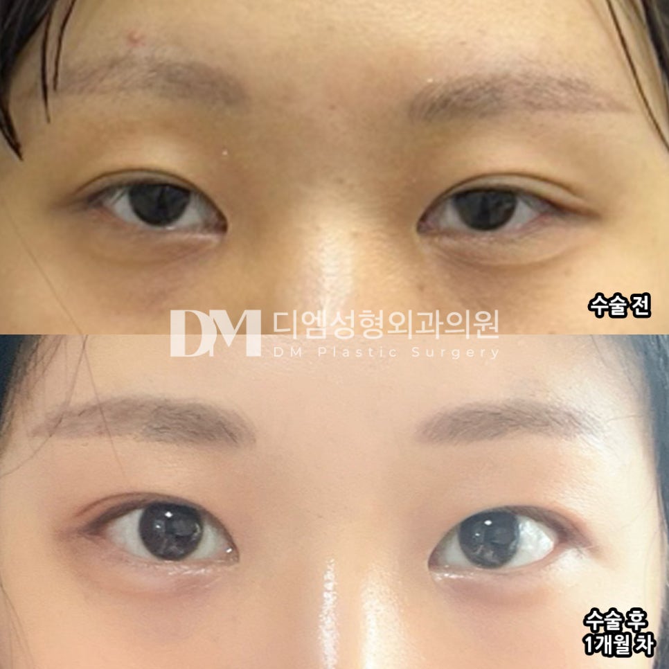 뒤밑트임, 사납거나 답답한 눈매 고민 해결 관련 이미지 5