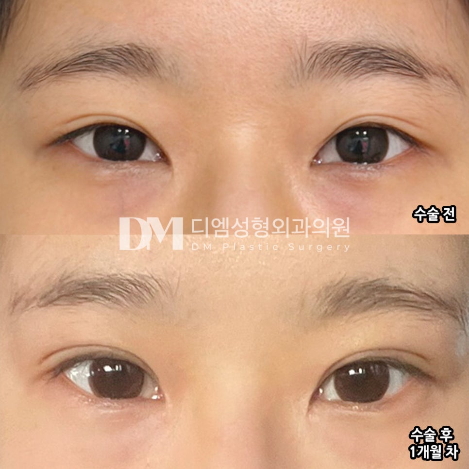 디엠 눈재수술/눈매교정 수술후기, “라인이 어떻게 자리 잡을지 궁금하고 설렙니다!” 관련 이미지 2