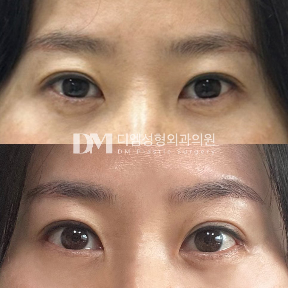 Eye-Opening Surgery Review: “I’m Very Satisfied with the Surgery!” image 2