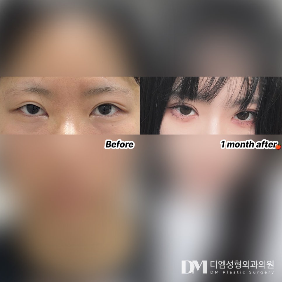 Revision Eyelid Surgery Review. "The result is really the best! My friends all said I became prettier!" image 2