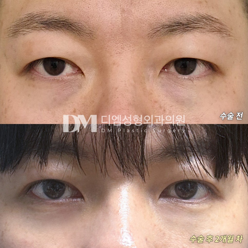 Revision Eyelid Surgery Review. “The swelling and scar have improved quickly, and there are no side effects!” image 2