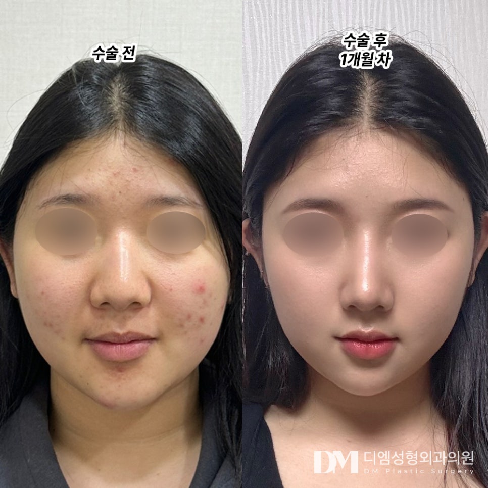 복코성형, 동글동글 뭉툭한 코 개선하려면 관련 이미지 10