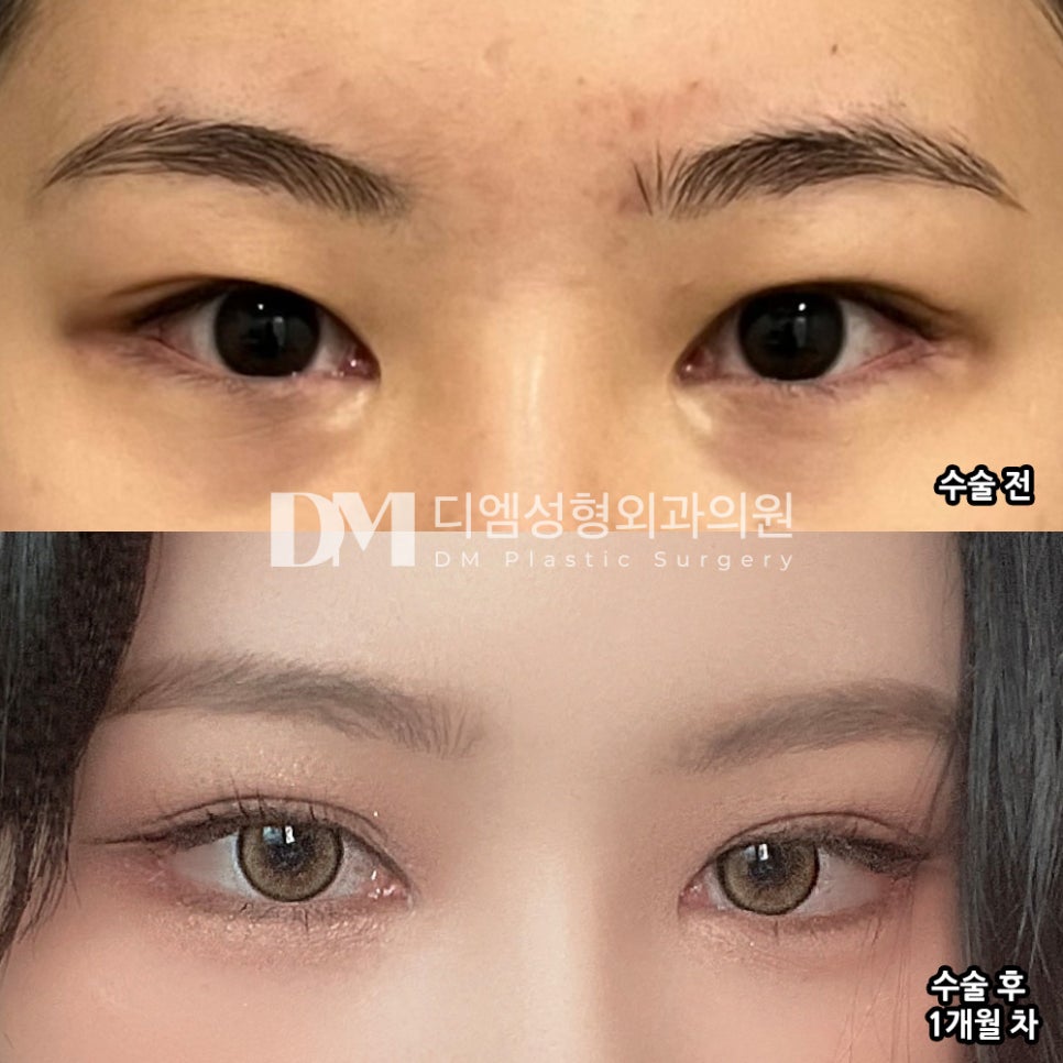 눈성형 후기."요즘 화장할 맛 나서 너무 만족스러워요~!" 관련 이미지 2