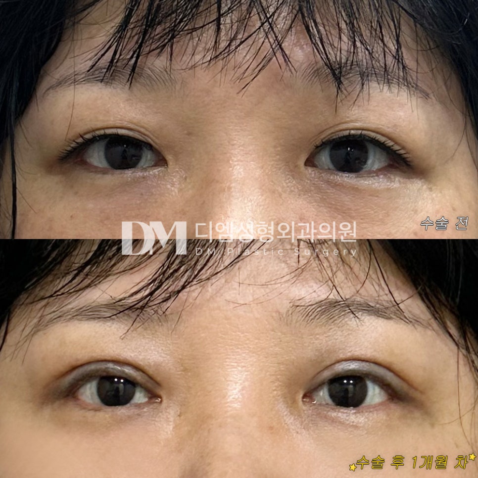 상안검 후기."붓기나 멍도 적고 눈매 라인이 뚜렷해서 너무 좋습니당 !" 관련 이미지 2