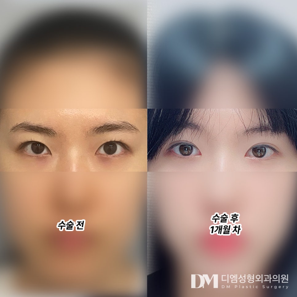 Blepharoplasty Review. "Now that it’s been a month, it looks even more natural, so I’m satisfied!" image 2