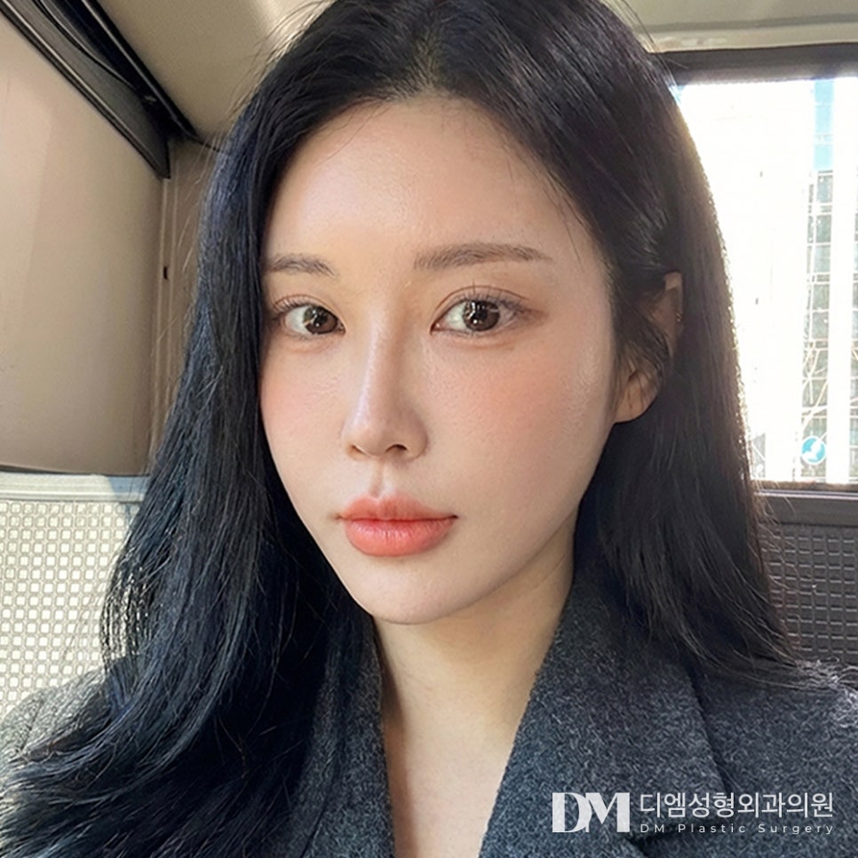 When Is the Best Time to Have Revision Double Eyelid Surgery Again? image 2