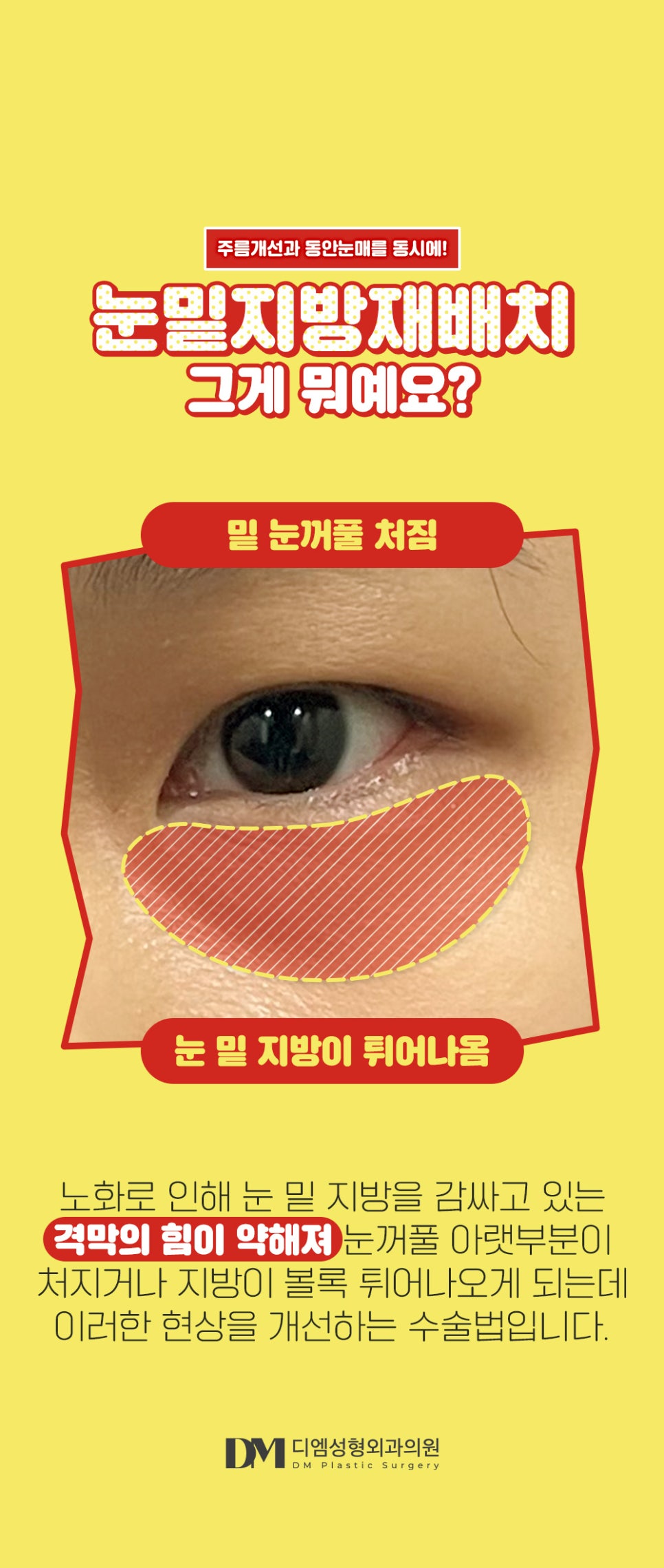 눈 밑 개선으로 환한 동안 인상 되기 관련 이미지 2
