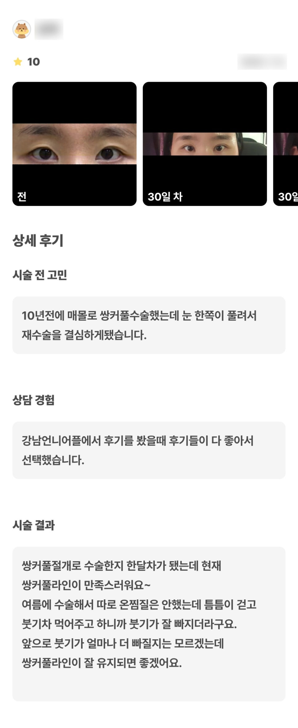 눈재수술 후기."현재 쌍꺼풀 라인이 만족스러워요!" 관련 이미지 1
