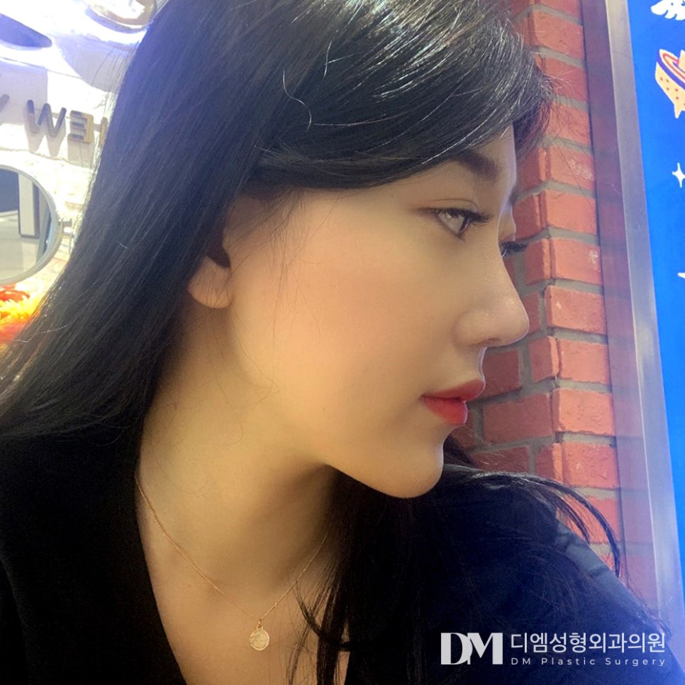 코재수술, 들리고 짧아지는 코 끝 해결하기 관련 이미지 13