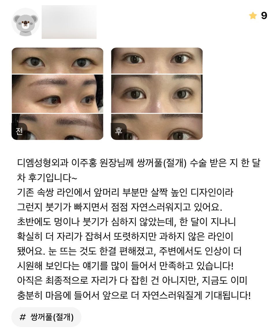 눈성형 후기."주변에서도 인상이 더 시원해 보인다고 해서 만족중입니다!" 관련 이미지 1