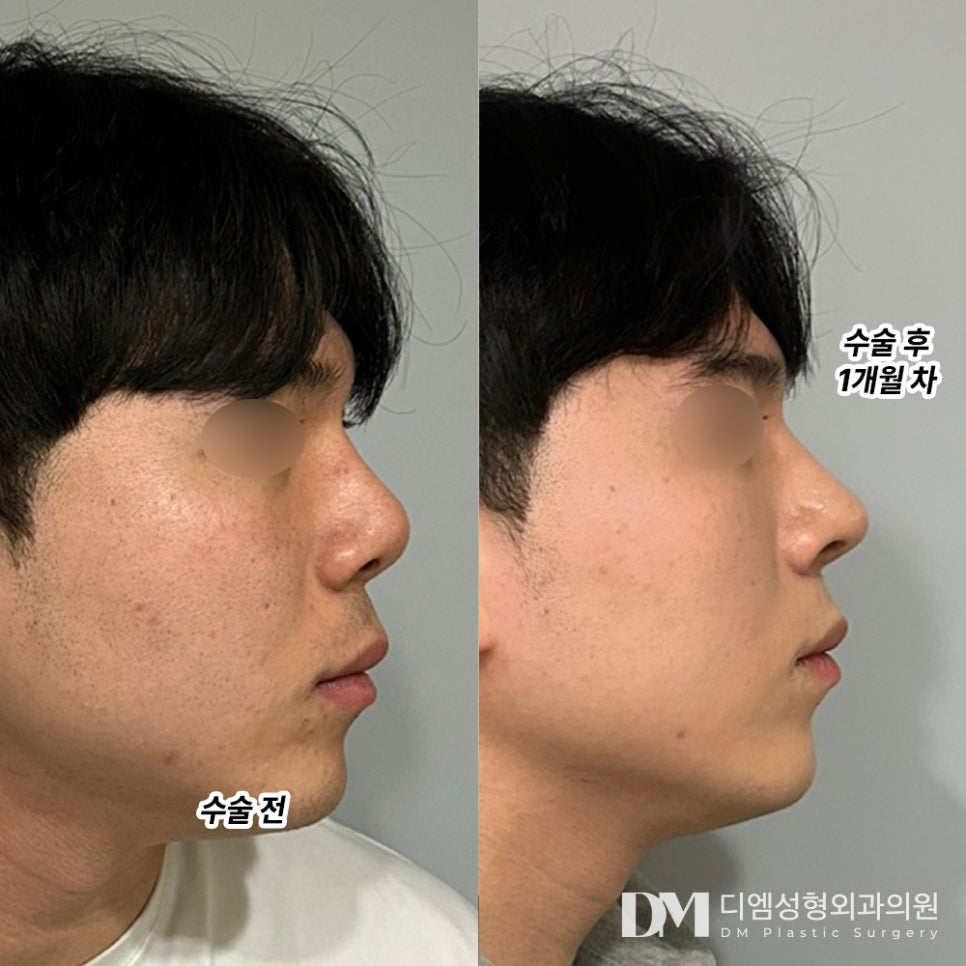 코재수술, 첫코성형 실패 원인 분석이 우선! 관련 이미지 10