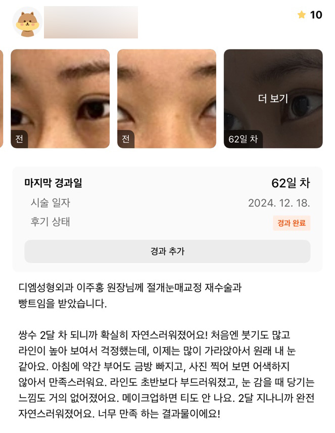 눈성형 후기."너무 만족해요 !!" 관련 이미지 1