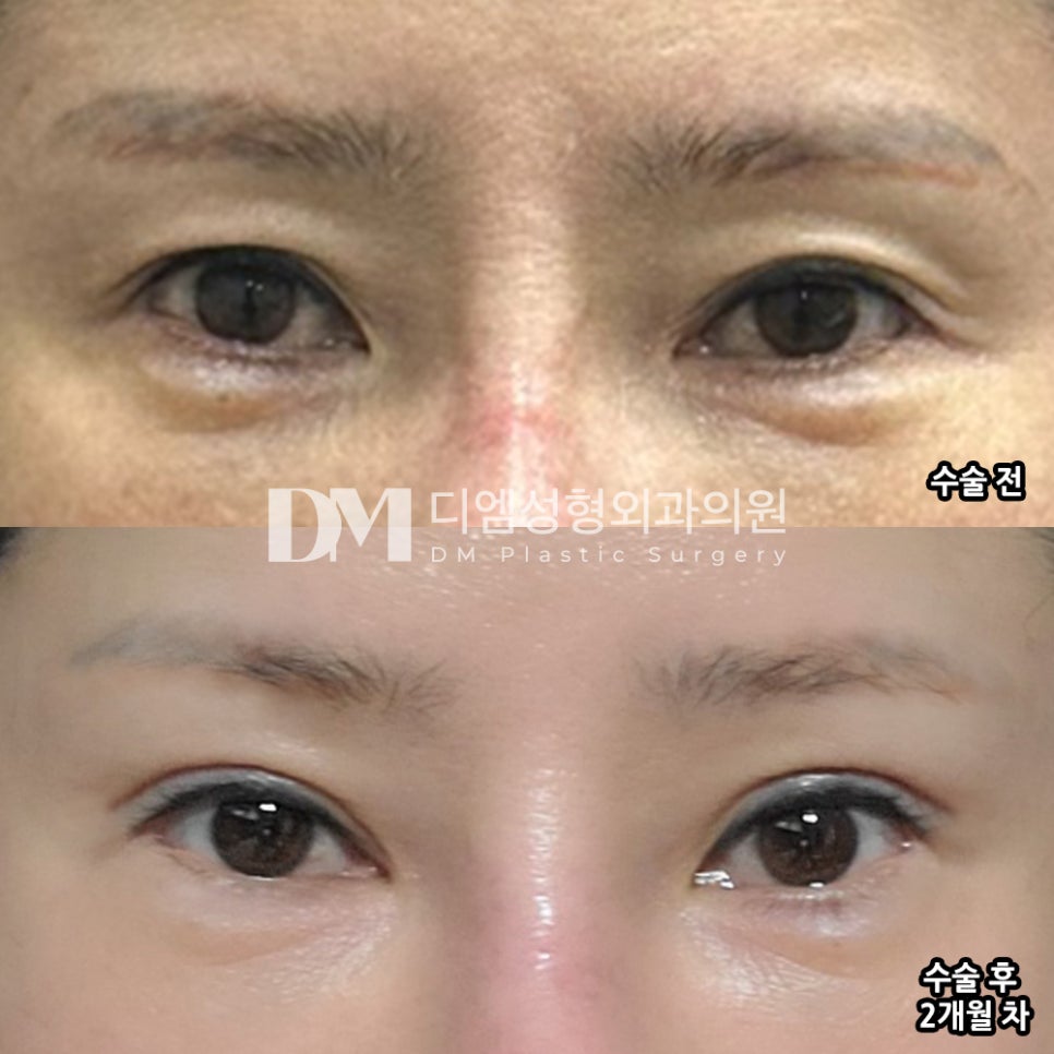 Eyelid Surgery Review: “It looks so natural that even people I know can’t really tell!” image 2