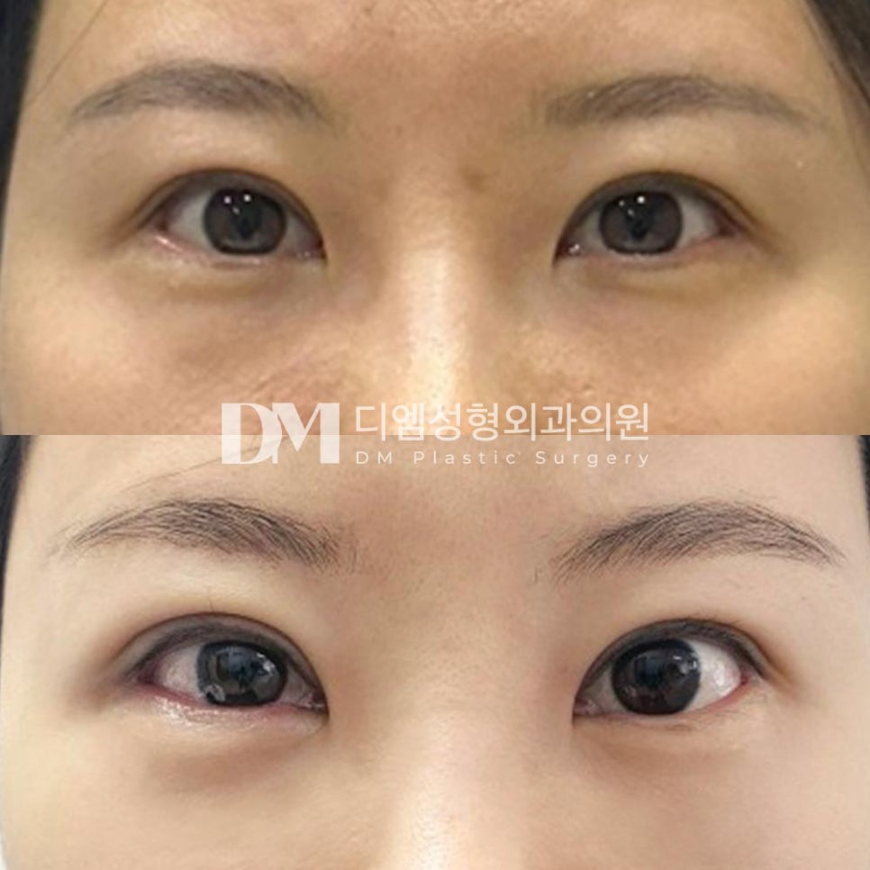 눈밑지방재배치 후기."너무 만족스럽습니다!" 관련 이미지 2
