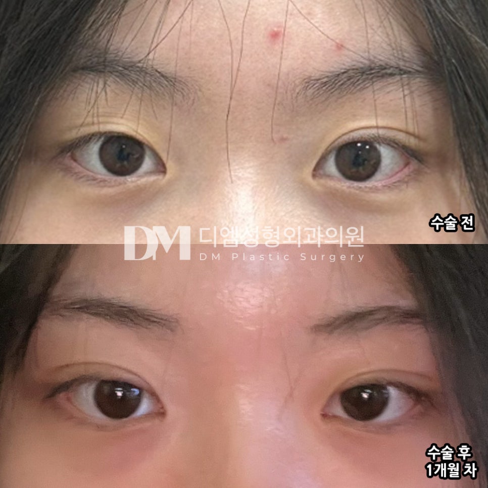 눈성형 후기."원하는 라인으로 잘 된거 같아서 만족해요!" 관련 이미지 2