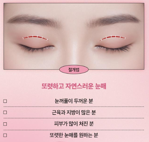 쌍꺼풀수술, 내 눈매에 맞는 자연스러운 라인으로 관련 이미지 9