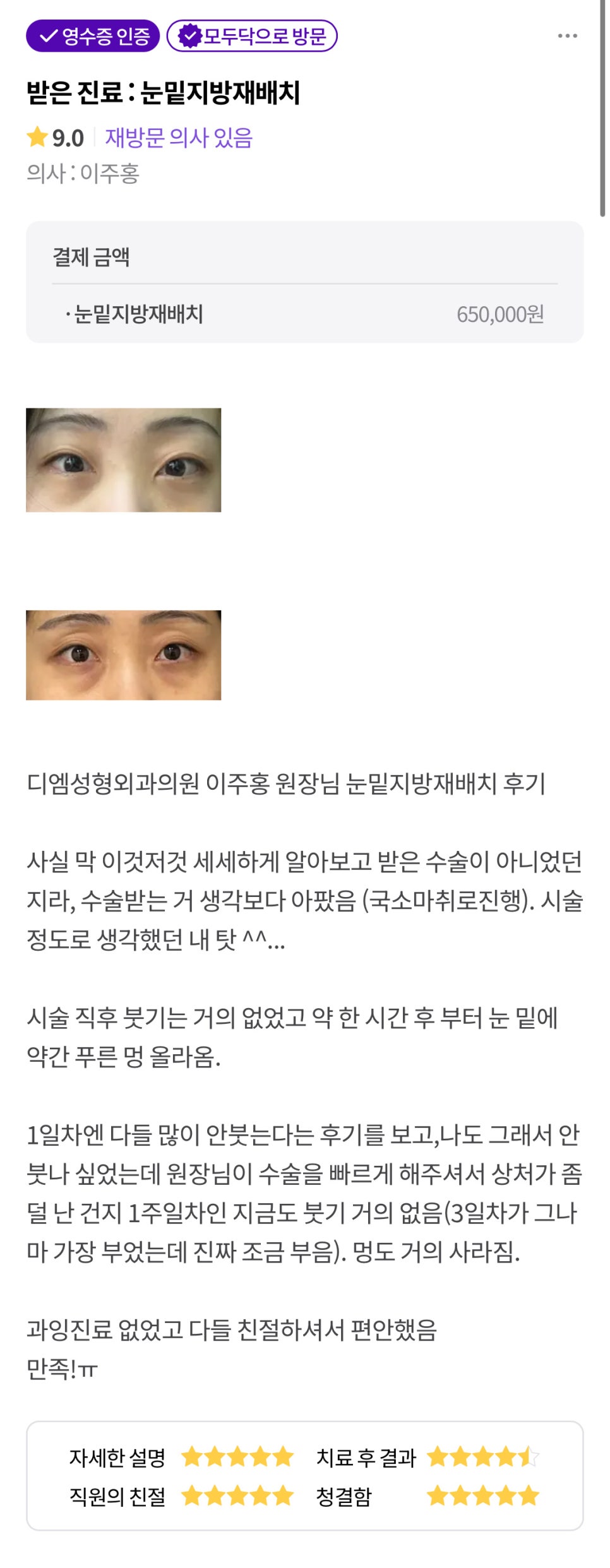 Lower Blepharoplasty Fat Repositioning Review. "The director did the surgery quickly, so maybe the incision was less damaged—there is almost no swelling even now, one week later!" image 1