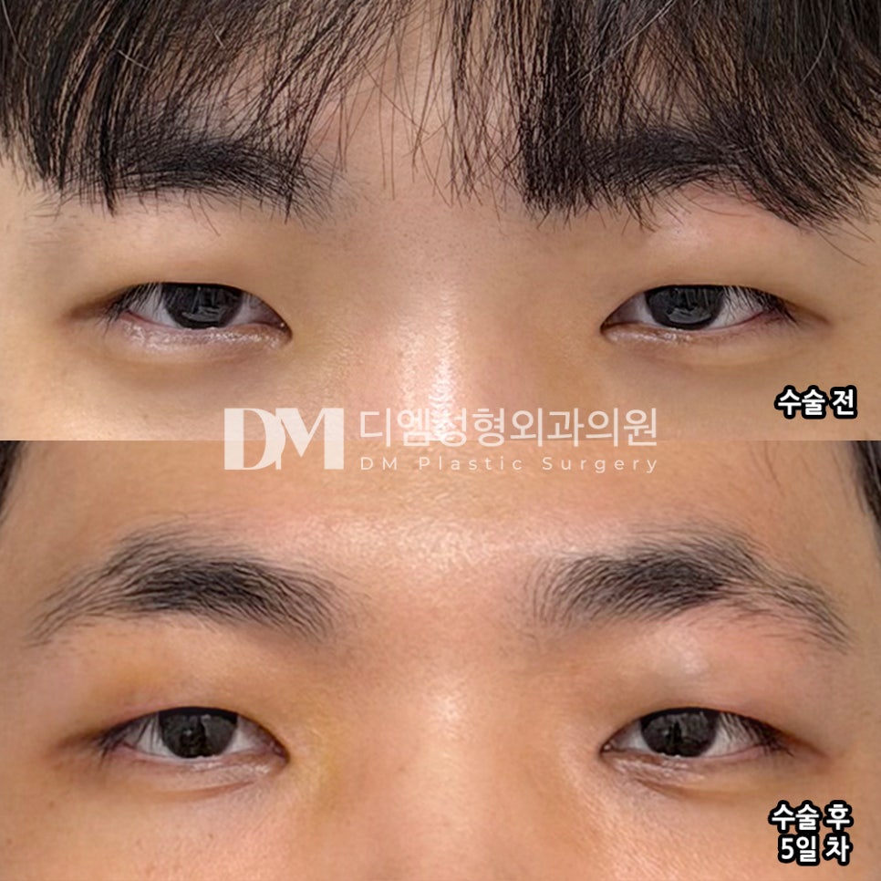 디엠 눈두덩이 지방제거 수술후기, &ldquo;전보다 눈이 덜 답답해 보여서 만족합니다!&rdquo; 관련 이미지 2