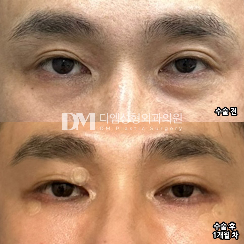 Lower Blepharoplasty Review: “I Recommend It If You’re Considering It!” image 2