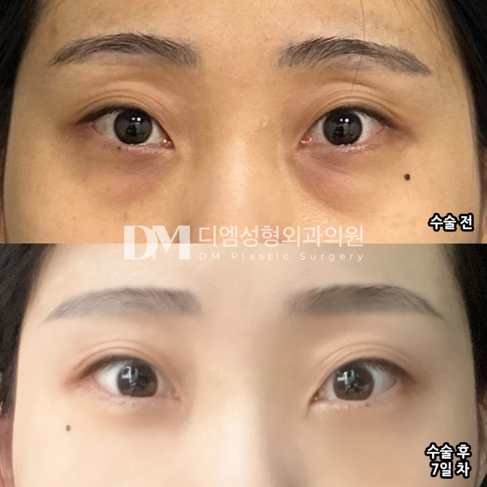 Lower Blepharoplasty Fat Repositioning Review. "The director did the surgery quickly, so maybe the incision was less damaged—there is almost no swelling even now, one week later!" image 2