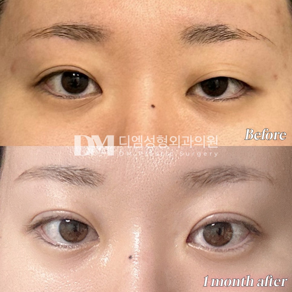 Double Eyelid Revision Surgery Review. "The line stayed exactly the natural line I wanted, so I’ve been satisfied every time I look in the mirror!" image 2