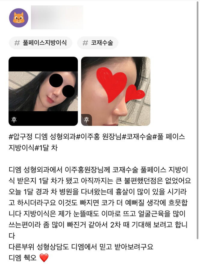 Rhinoplasty Review. "I feel delighted thinking about my nose becoming even prettier!" image 1