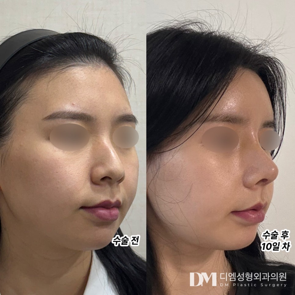 Plastic Surgery Review. "Once the swelling goes down and everything settles, I think the line will look really, really beautiful!" image 2