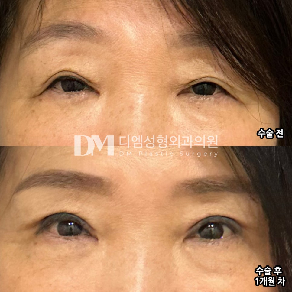 시야를 방해하는 처진 눈두덩이가 고민이라면? 관련 이미지 11
