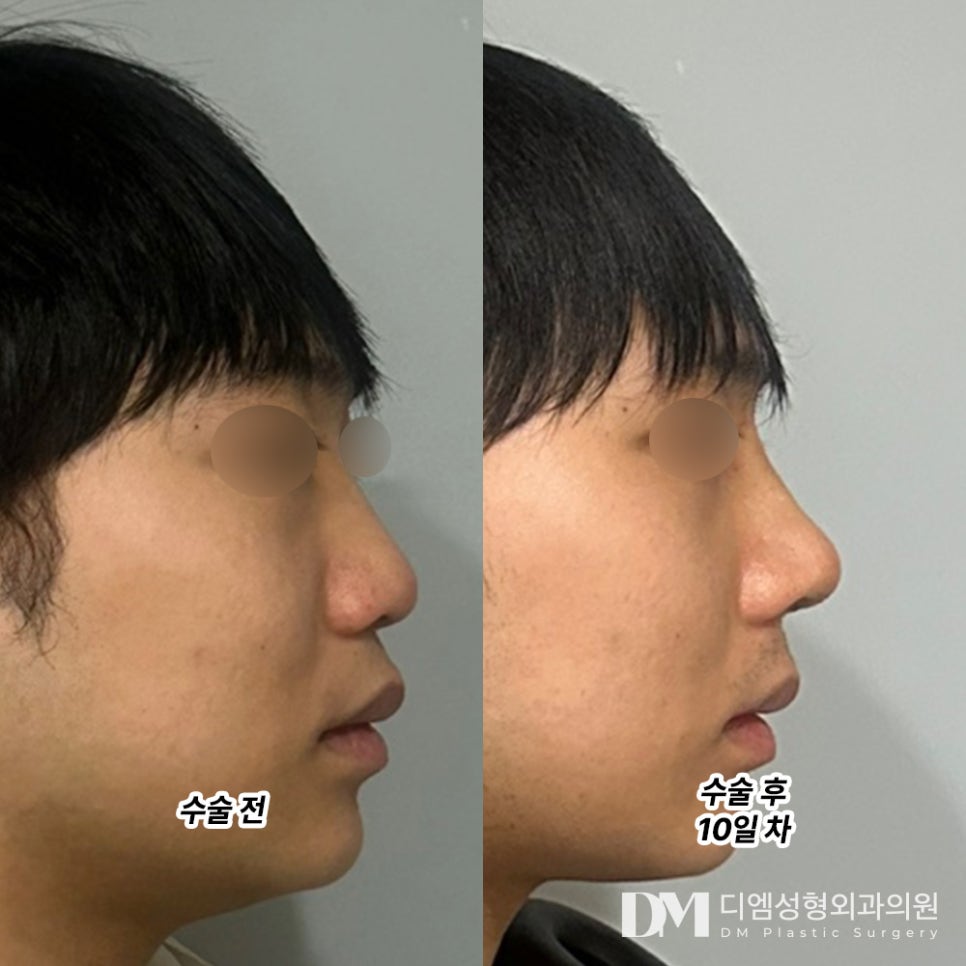 Nose Surgery Review. “I only had my nose done, but people around me said I did well and that I looked handsome, so I’m really happy!” image 2