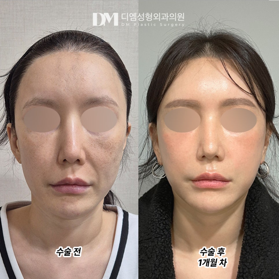 디엠 안면거상 수술후기, &ldquo;숨어있던 브이라인도 생기고 어려 보인다는 얘기 자주 들어요!&rdquo; 관련 이미지 2