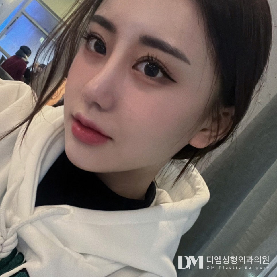 Facial Fat Grafting: Adding Natural Volume to the Face image 9