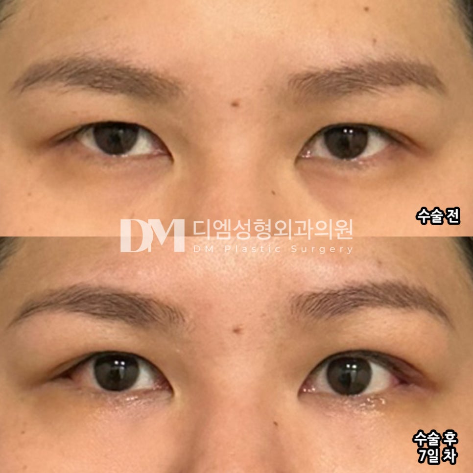 빵트임 후기."다들 다른 병원에서 시간 낭비 하지 마시고 디엠에서 하세요!!!!" 관련 이미지 2