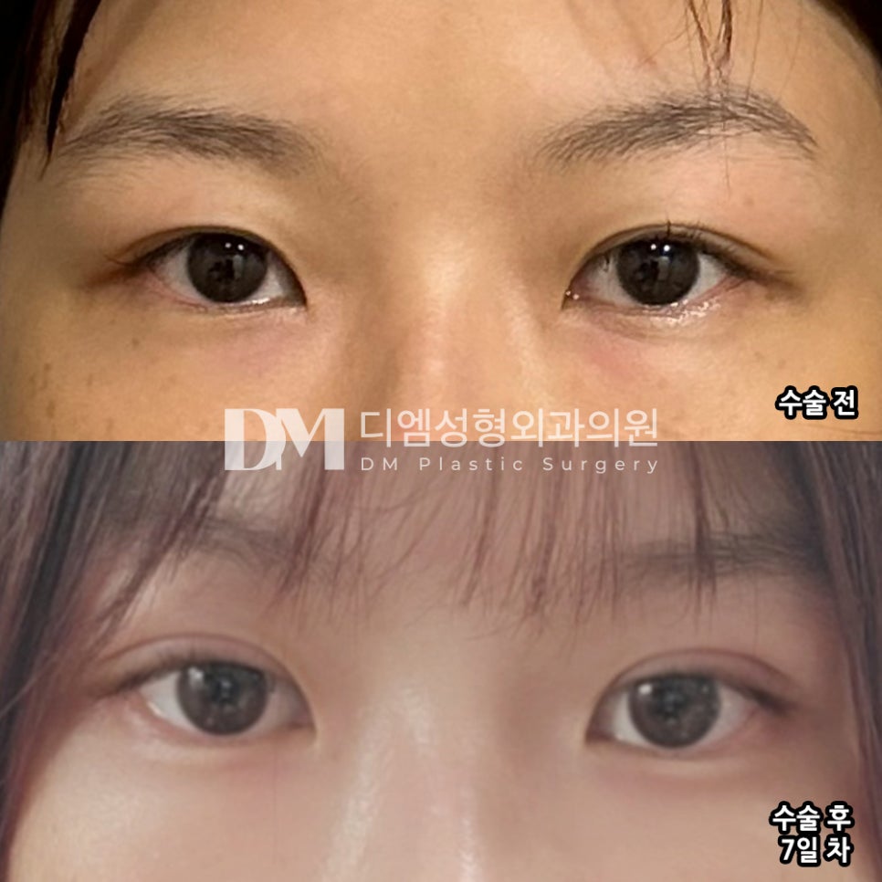 눈재수술 후기."주변에서 일주일만에 벌써 괜찮다는 말을 많이 들었어요!" 관련 이미지 2