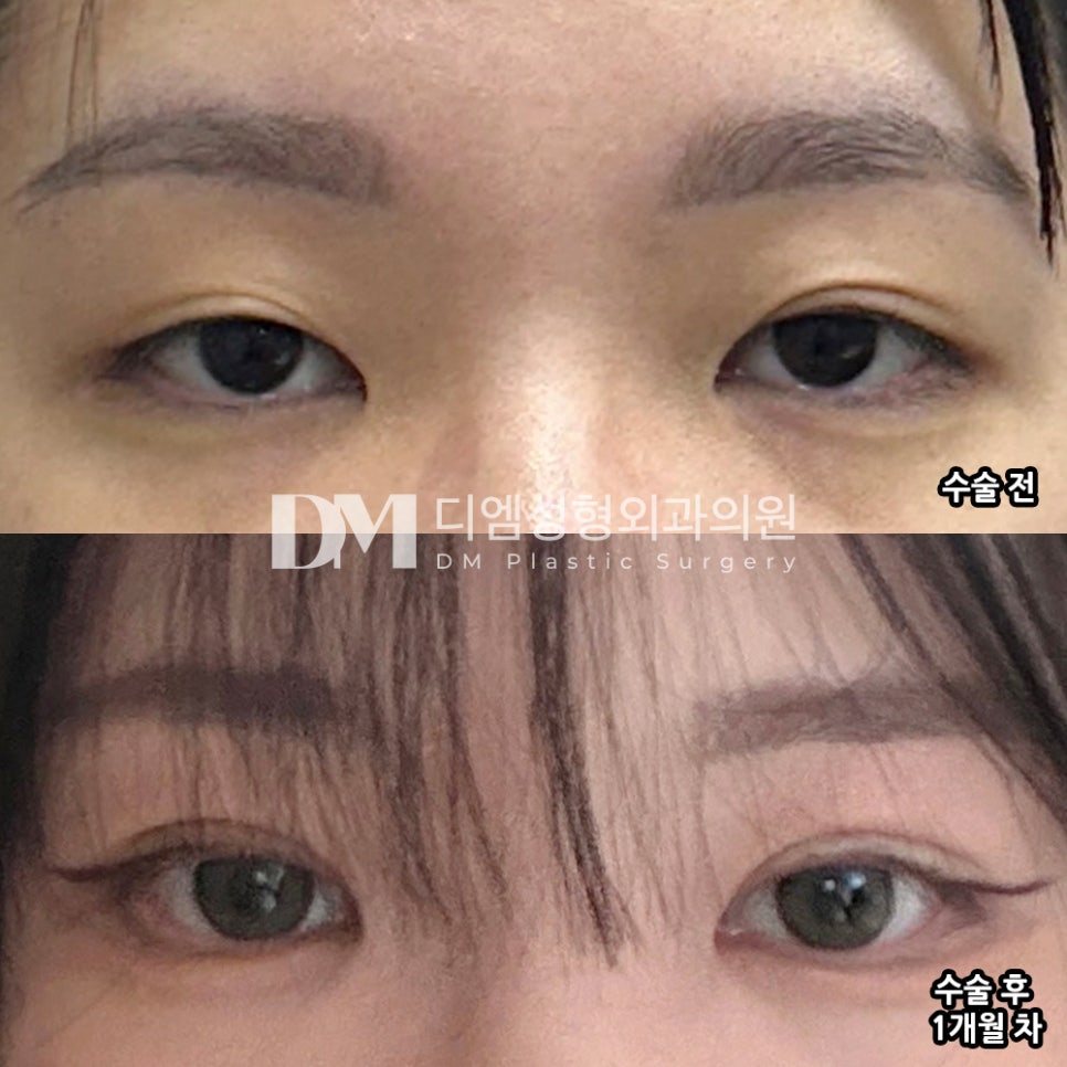 DM Reoperation for Double Eyelids / Ptosis Correction Surgery Review, “I trusted them because they explained everything realistically!” image 2