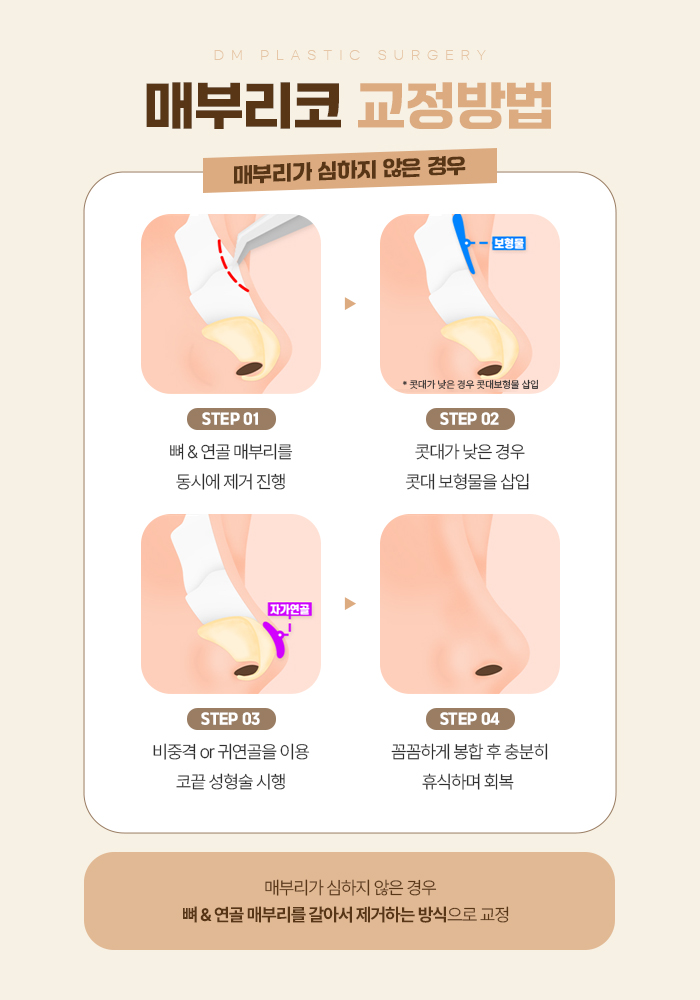 매부리코, 굴곡진 콧대가 고민이라면 관련 이미지 5