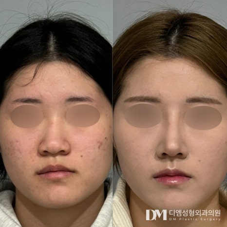 코성형 후기."더 빨리할 걸 후회하고 있습니다 !" 관련 이미지 2