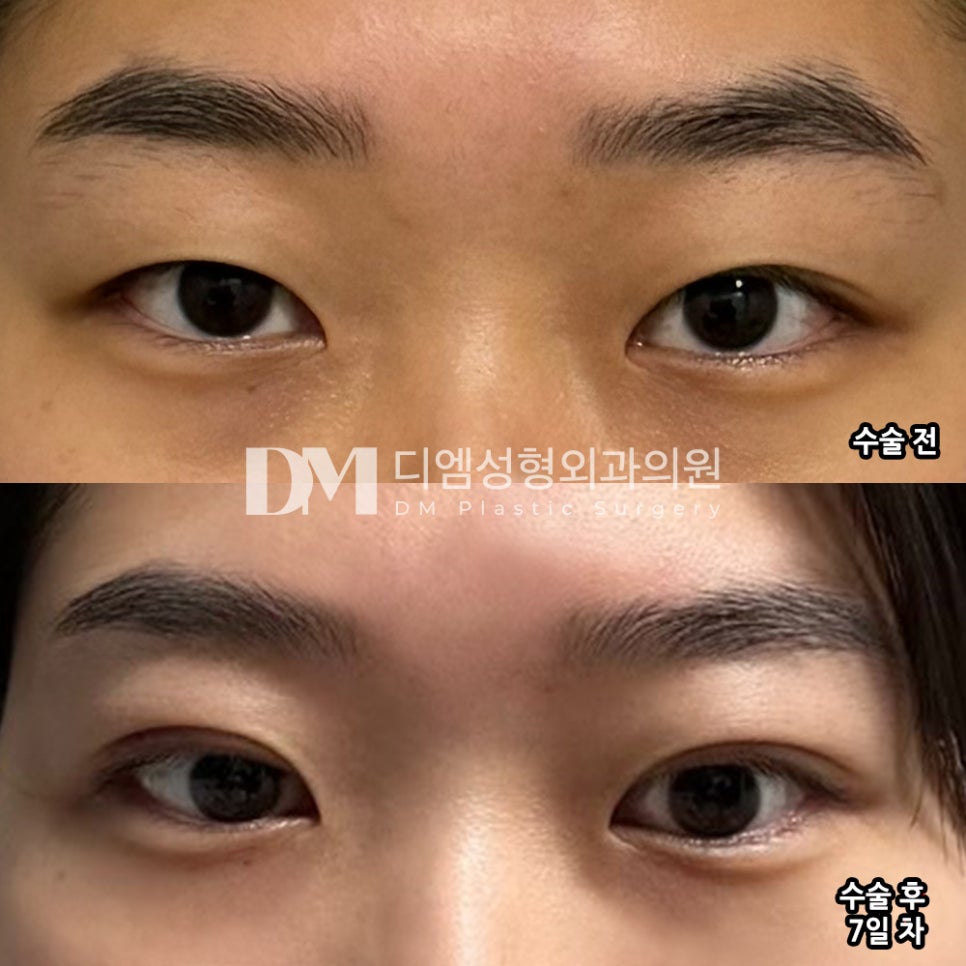 눈성형 후기."라인도 마음에 들고 만족스러워요!" 관련 이미지 2