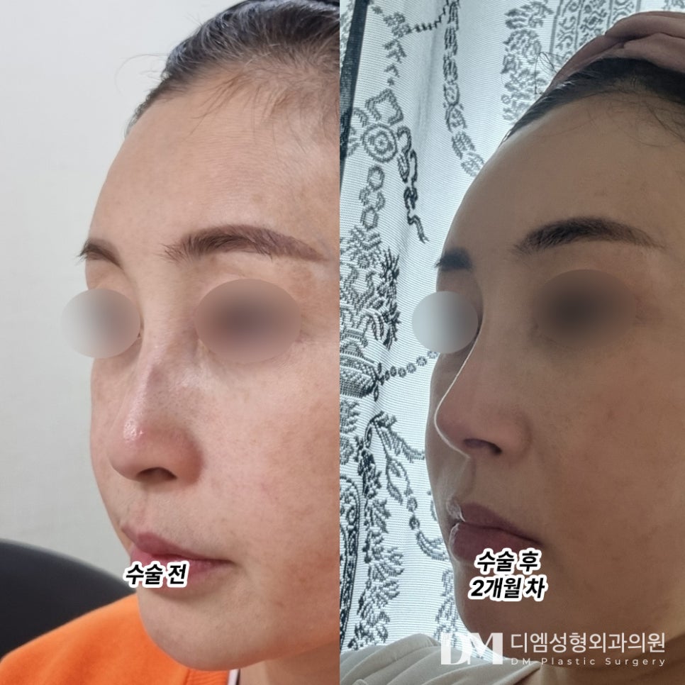 화살코성형, 어느각도에서도 예쁜 코로 변신하기 관련 이미지 6