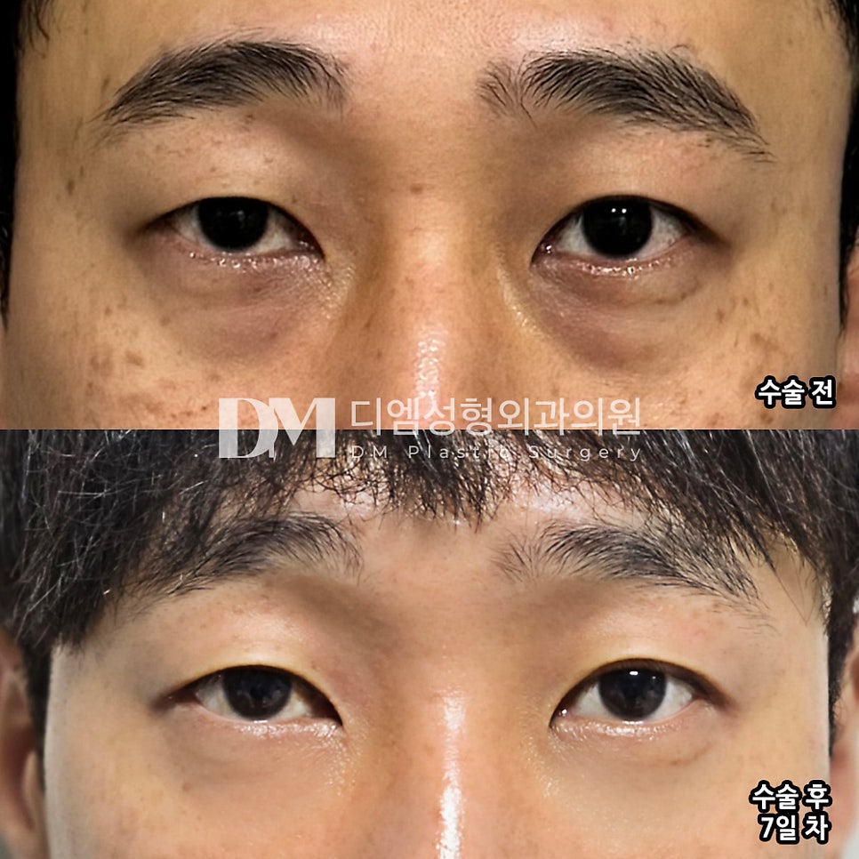 눈밑지방재배치 후기."눈에 띄게 변한걸 인지하고 어느병원인지 물어보는 사람도 있을 정도로 경과가 좋네요!" 관련 이미지 2