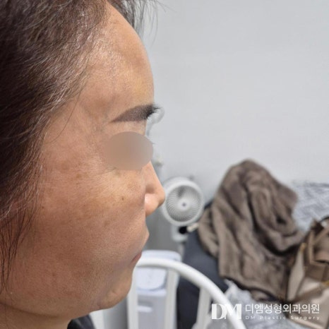 얼굴지방이식 후기."10년은 더 젊어보인다 난리도 아니네요~~" 관련 이미지 3
