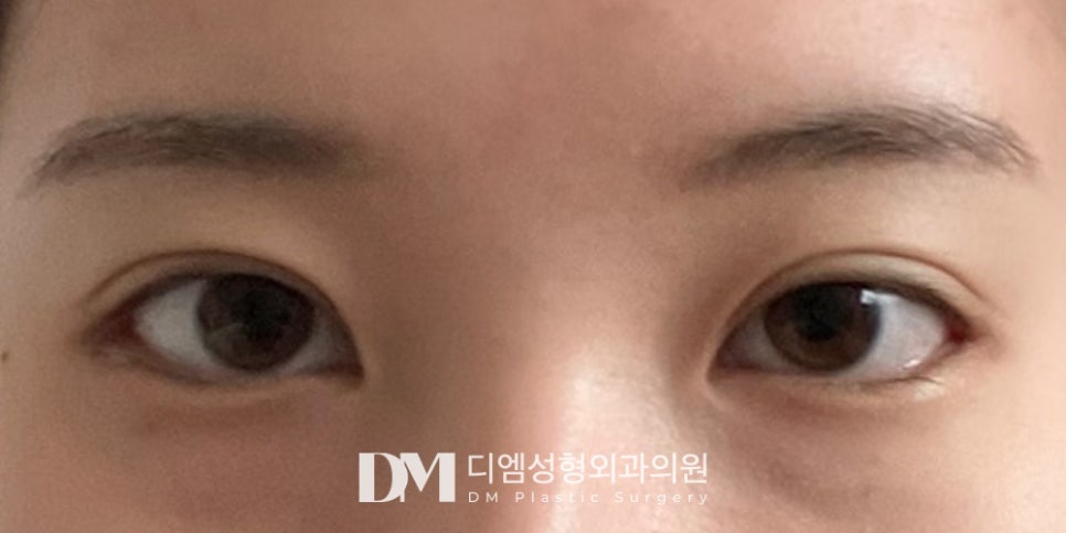 DM’s Expertise-Driven Lower-Lateral Eye Opening image 6
