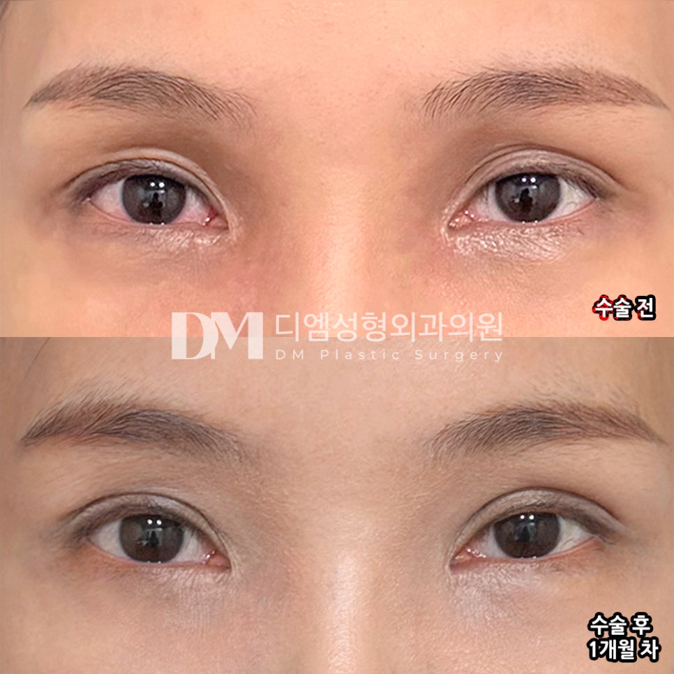 DM Revision Eyelid Surgery/Eye-Shape Correction Surgery Review, “The Doctor Refined the Eyelid Line So Well!” image 2