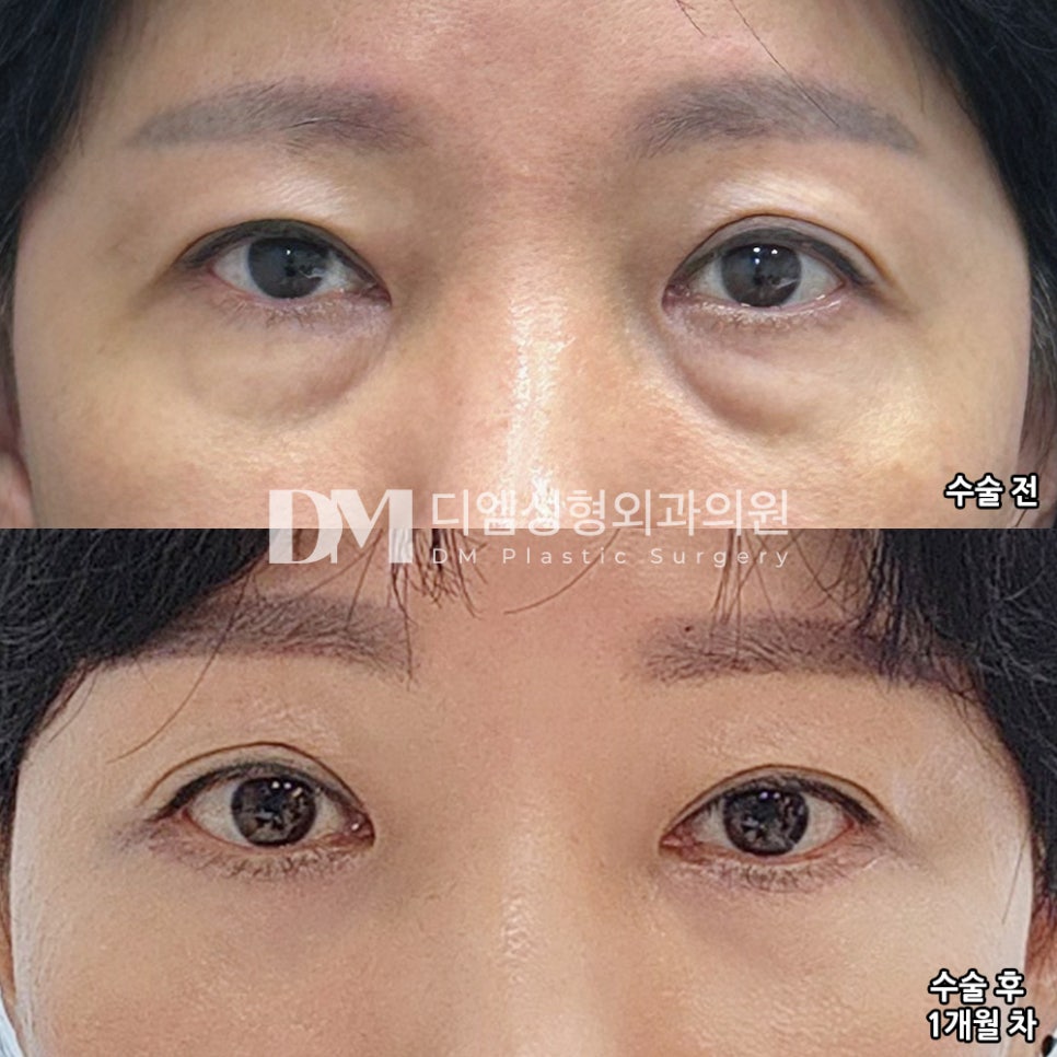 Lower Eyelid Surgery: Improve Under-Eye Aging and Transform Your Look for a More Youthful Appearance! image 7