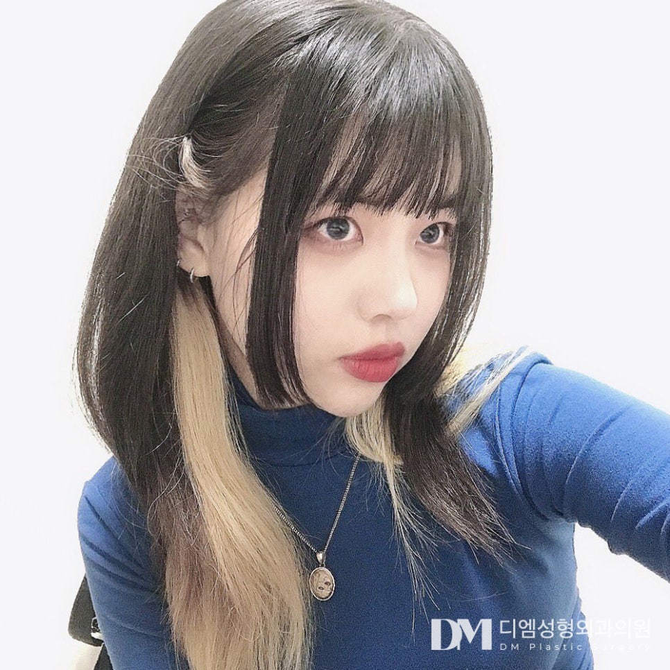 코끝성형, 입체적인 얼굴로! 관련 이미지 12