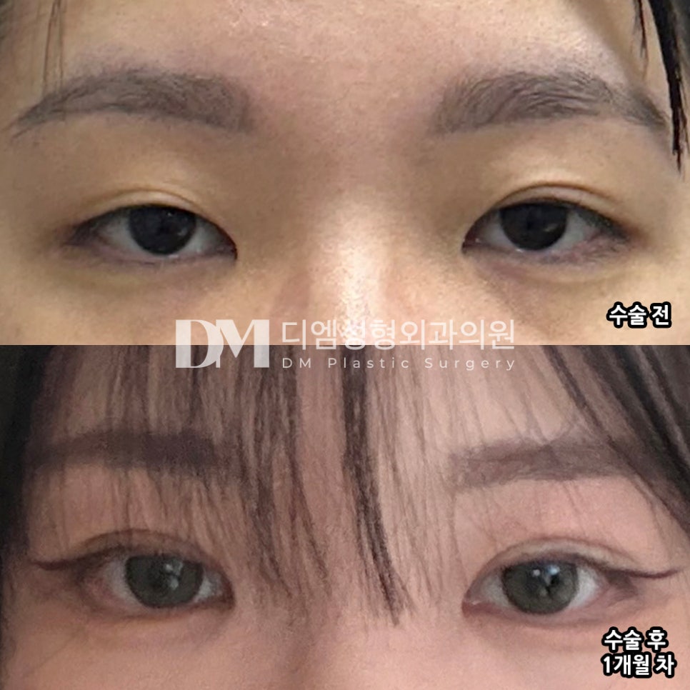 디엠 눈재수술 후기, &ldquo;제 눈에 맞춰 상담해주셔서 신뢰가 갔어요!&rdquo; 관련 이미지 2